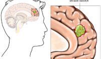 brain tumor