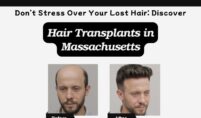 Dont-Stress-Over-Your-Lost-Hair-Discover-Hair-Transplants-in-Massachusetts