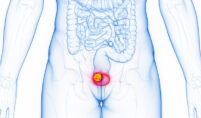 Bladder Cancer