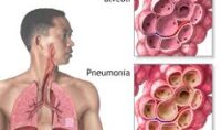 Community Acquired Pneumonia