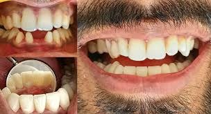 Dental Bridges, Veneers, Crowns and More