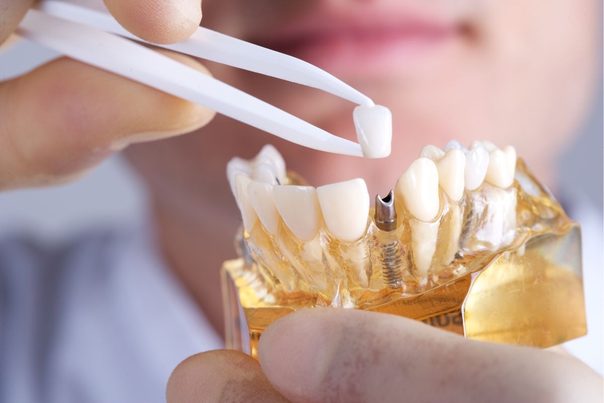 Dental Implants Provide a Sturdy Foundation For Replacement Teeth