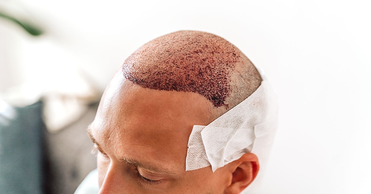 What Influences Hair Transplant Cost