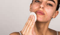 The Benefits of Isotroin 20mg: A Game-Changer for Acne-Prone Skin