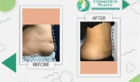 Liposuction in Lahore