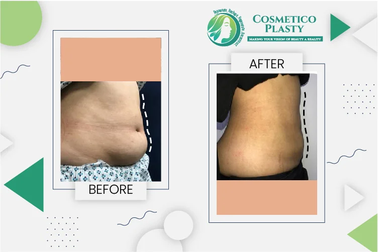 Liposuction in Lahore