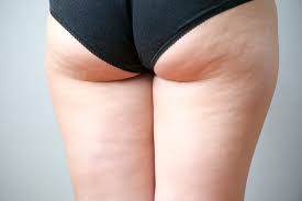 What Is Cellulite and How Can It Be Treated Effectively?