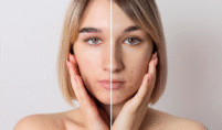 Melasma Treatment near me