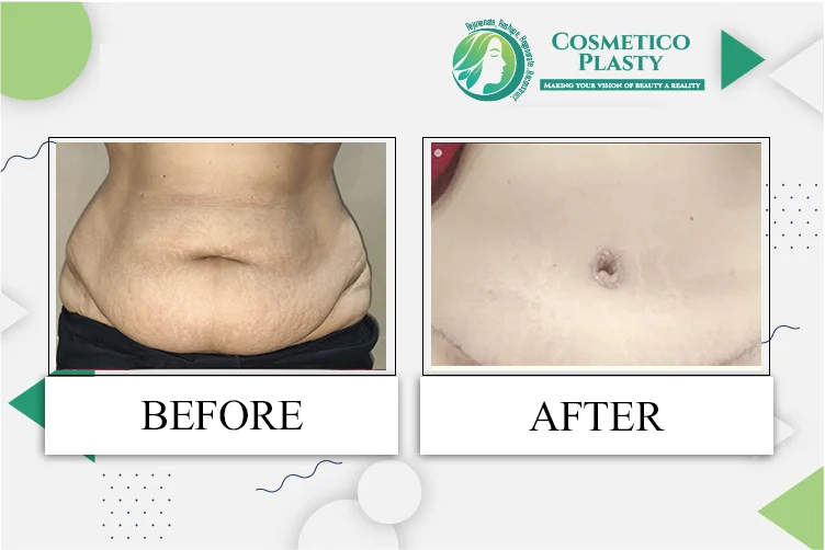Tummy Tuck