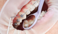 Orthodontic Treatment Medicine Hat
