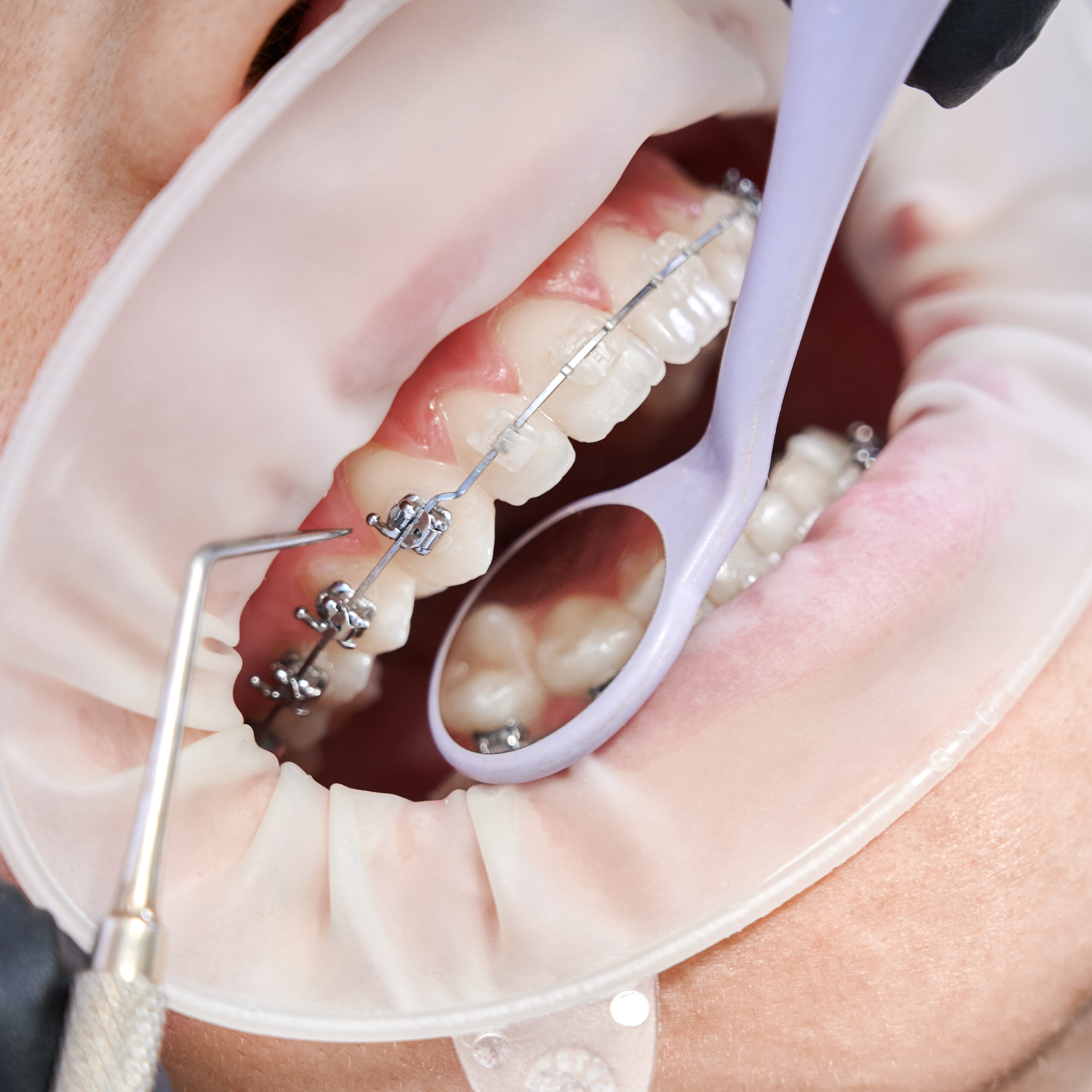 Orthodontic Treatment Medicine Hat