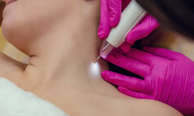 skin tag removal Toronto