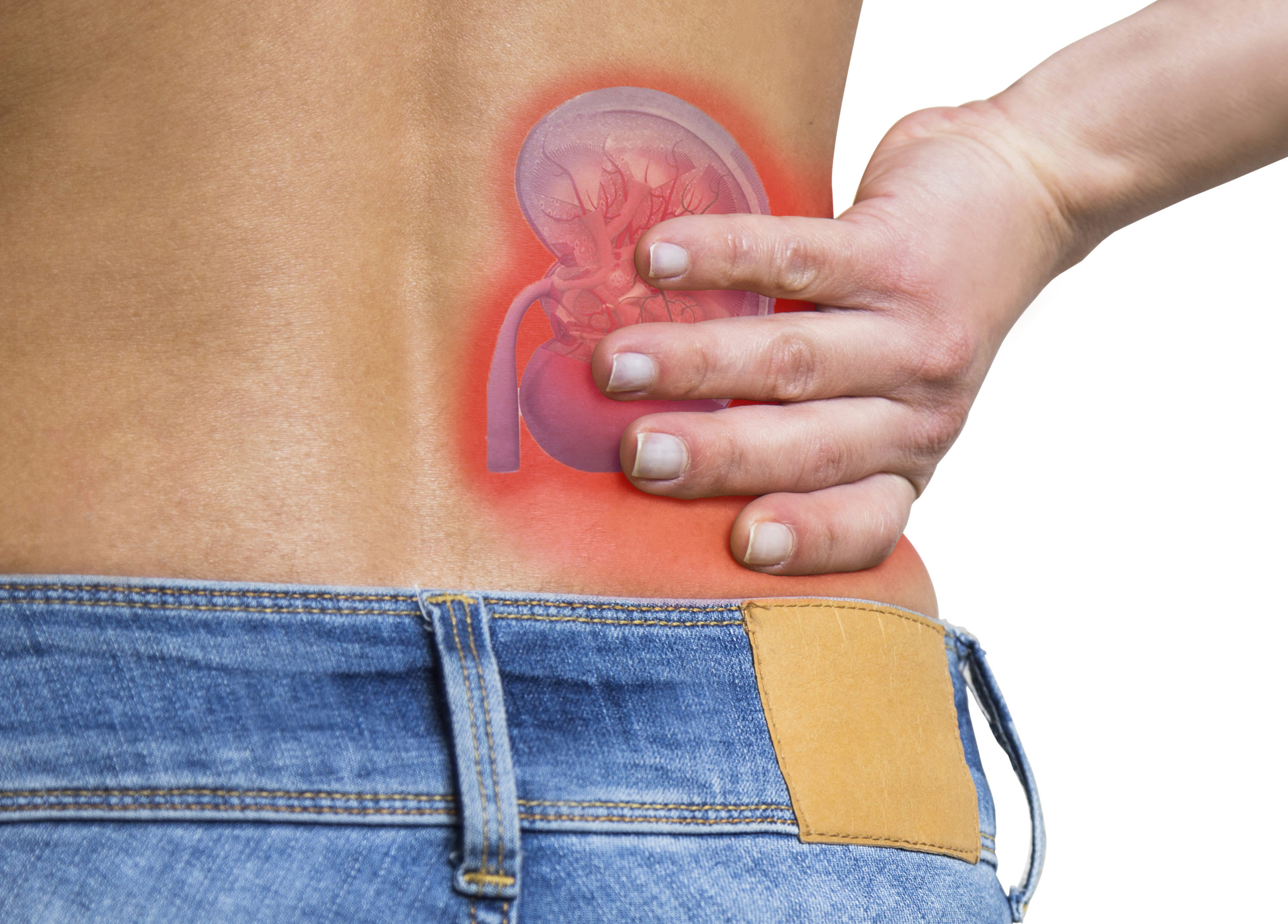 Back Pain a Sign of Kidney Stones
