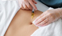 Fat Grafting Systems