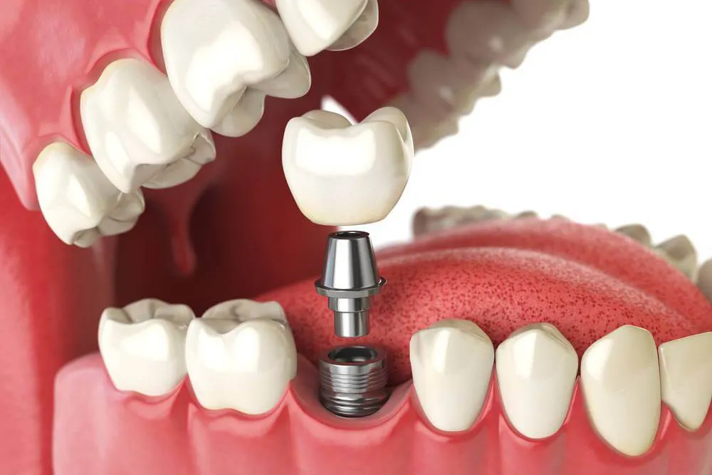 Dental implants