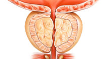 Benign Prostatic Hyperplasia (BPH): Symptoms & Treatment