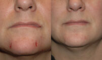 What Is Surgical Scar Revision and How Does It Work?