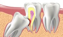 impacted wisdom teeth