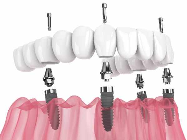 dental Implant Aberdeen