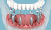 dental Implant Aberdeen