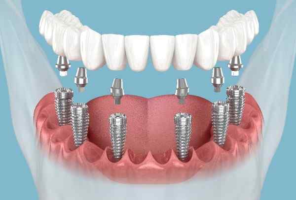 dental Implant Aberdeen