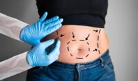 Can I lose 10 kg with Liposuction