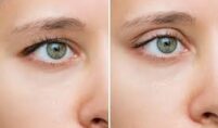 Upper vs Lower Eyelid Surgery: What’s the Difference?