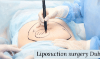 Liposuction surgery in Dubai